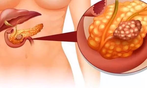 Để không bị viêm tụy cấp ngày Tết