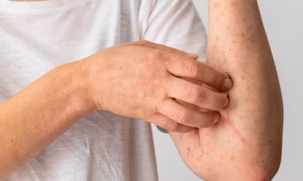 Cảnh báo bệnh về da thường gặp trong mùa hè và cách phòng tránh