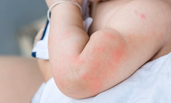 Bé trai phù mặt sau tắm lá chữa viêm da
