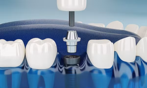 Vì sao chi phí trồng răng Implant cao hơn làm cầu răng sứ?