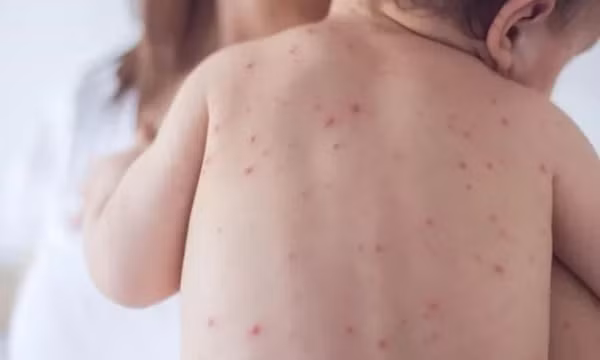 Đề phòng bệnh da liễu khi thời tiết nồm ẩm kéo dài