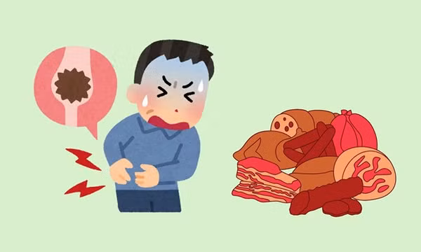 Tiêu thụ protein quá mức và nguy cơ hình thành sỏi thận