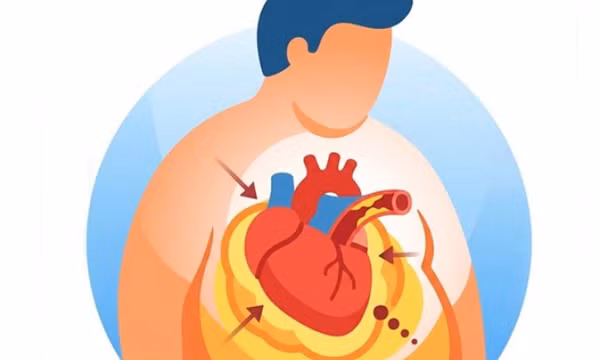 Béo phì có thể âm thầm tàn phá sức khỏe tim mạch