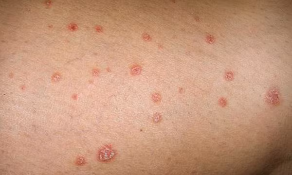 WHO lần đầu tiên xác định các bệnh về nấm là mối đe dọa với sức khỏe con người
