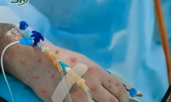 Nóng: Bệnh nhân đầu tiên mắc đậu mùa khỉ tại Việt Nam là nữ, khởi phát bệnh khi đang đi du lịch