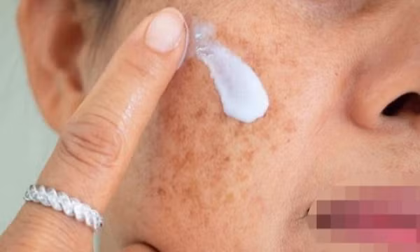 Cảnh báo mẫu kem chuyên nám có hàm lượng thủy ngân vượt mức