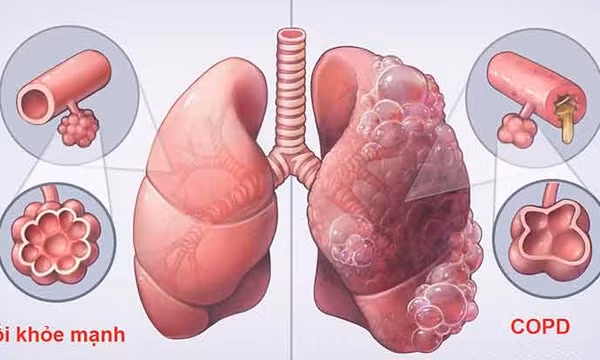 Phòng, chống bệnh phổi tắc nghẽn mạn tính