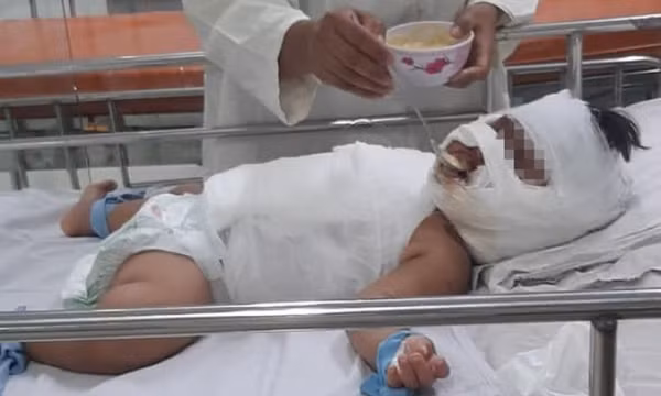 TPHCM: Bé gái 1 tuổi bỏng thương tâm vì ngã vào nồi nước sôi mẹ nấu
