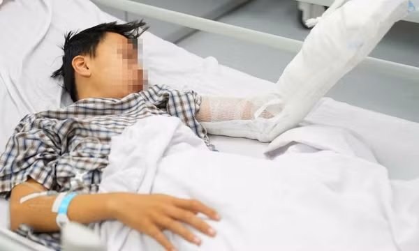 Thiếu niên bỏng mặt, nát tay do bình ga mini phát nổ