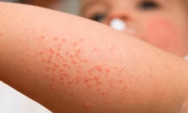 Cách phòng ngừa các bệnh về da vào mùa đông
