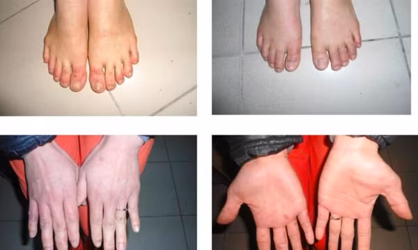 Ngón tay, chân sưng và ngứa vào mùa đông, xử trí ra sao?