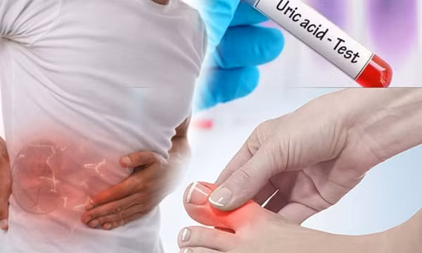 Mối liên quan giữa axit uric cao với gan và thận