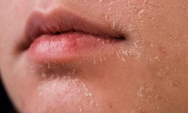 Sai lầm thường gặp khi chăm sóc da mùa đông
