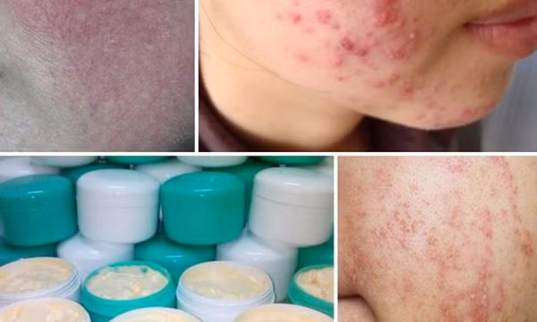 Dùng thuốc đông y, kem trộn chứa corticoid - Tiềm ẩn nhiều hệ lụy nguy hiểm