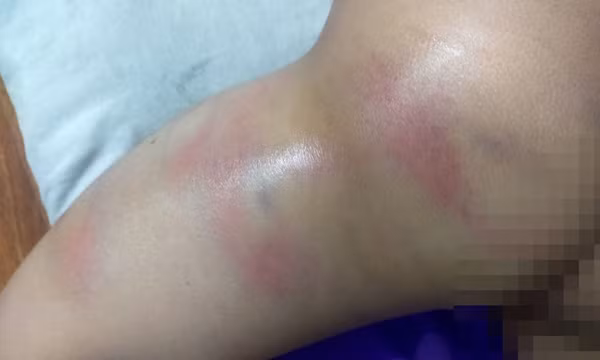 Xác minh vụ việc bé gái 4 tuổi nghi bị cô giáo đánh bầm tím