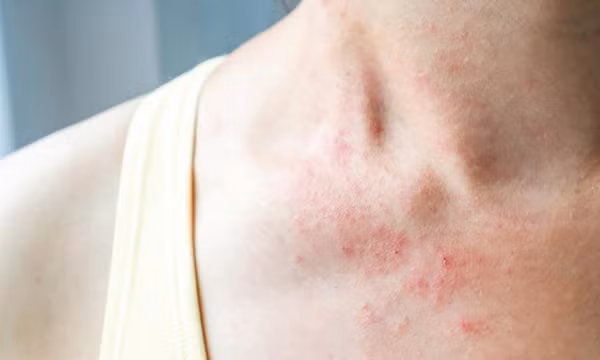 Thuốc điều trị viêm da dị ứng