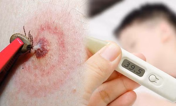 Sốt cao mê sảng, suy gan thận vì bị loại côn trùng cực độc đốt một nốt nhỏ xíu