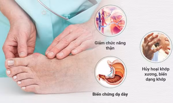 7 cách “chung sống hòa bình” với bệnh gout