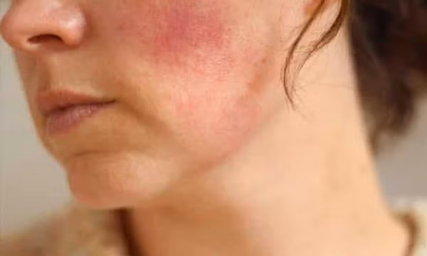 Biến chứng "chết người" khi lạm dụng, tự ý dùng Corticoid