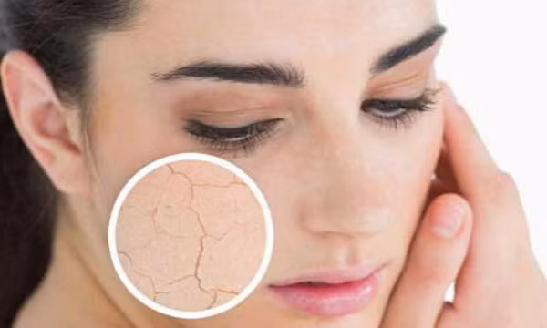 Nguyên nhân da khô, cách khắc phục và phòng ngừa da khô bong tróc