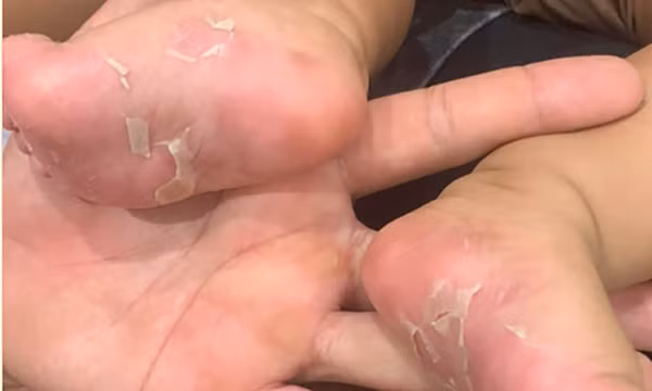 Bé 3 tháng tuổi mắc giang mai