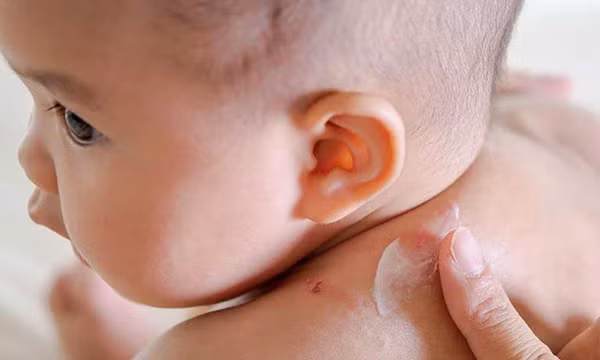 Viêm da cơ địa ở trẻ em dễ tái phát, biện pháp chăm sóc da đúng cách