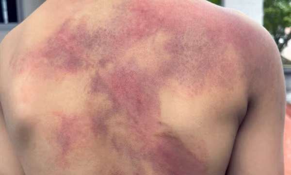 Bé trai 5 tuổi chi chít vết thương khắp người do cha ruột đánh