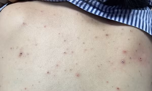 Nhóm bệnh nhân mãn tính mắc thủy đậu sẽ có nhiều biến chứng