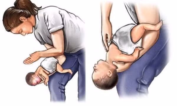 Bác sĩ hướng dẫn cách giúp trẻ thoát hiểm khi hóc dị vật đường thở