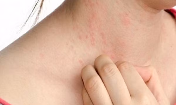 Cách phòng ngừa các bệnh dị ứng khi trời nóng nực