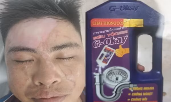 Dùng nước thông cống siêu tốc, nhiều người bỏng phải nhập viện cấp cứu