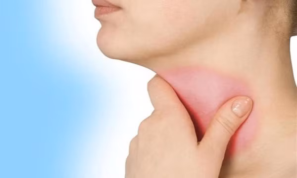 Dấu hiệu viêm họng kéo dài cảnh báo bệnh nguy hiểm