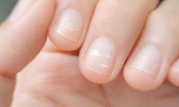 Dấu hiệu nhỏ trên móng tay cảnh báo nhiều nguy cơ tiềm ẩn