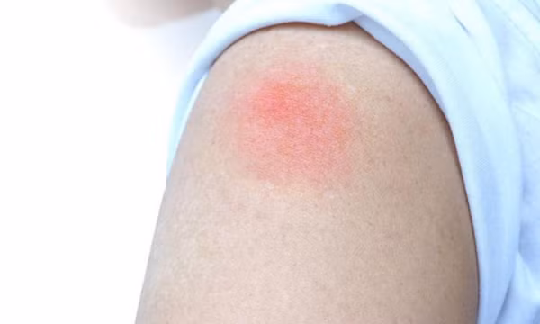 Hiện tượng 'cánh tay COVID' sau tiêm vaccine ở trẻ: Cha mẹ cần nhớ điều này