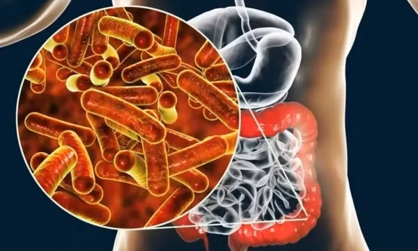 Chủng nấm men trong ruột tạo ra độc tố gây viêm loét đại tràng