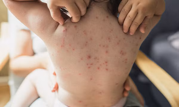 Bệnh thủy đậu vào mùa và những lưu ý khi dùng thuốc
