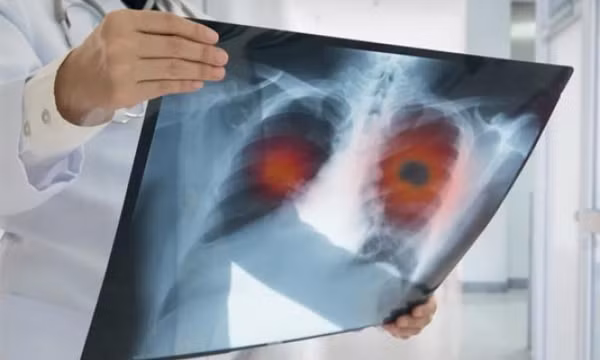 Các yếu tố âm thầm tăng nguy cơ ung thư phổi