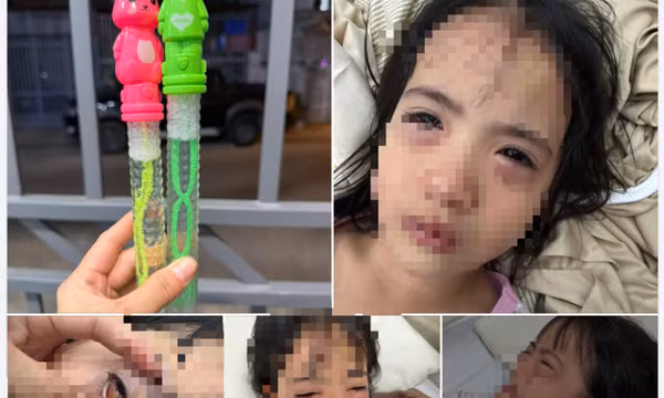 Chơi bong bóng xà phòng, bé gái 5 tuổi nhập viện vì viêm kết mạc