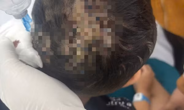 Bé trai 5 tuổi bị chó cắn rách da đầu, lộ xương sọ