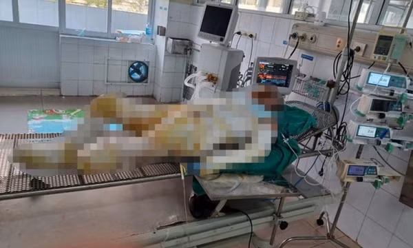 Vụ con gái phóng hỏa nhà mẹ: Người mẹ được ghép da