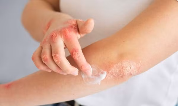 Những biện pháp tránh ngứa, dị ứng trong mùa mưa lũ