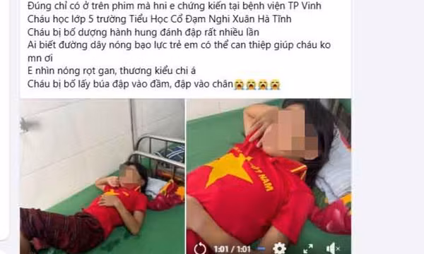 Xác minh thông tin bé gái bị cha dượng đánh bầm tím phải nhập viện