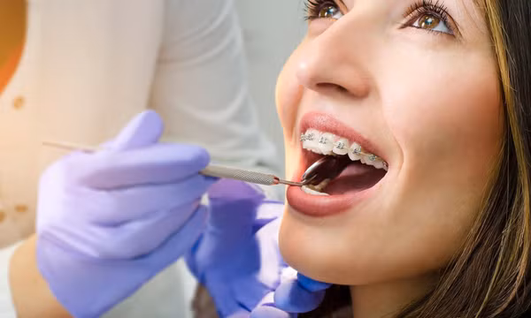 5 loại thực phẩm nên kiêng khi niềng răng