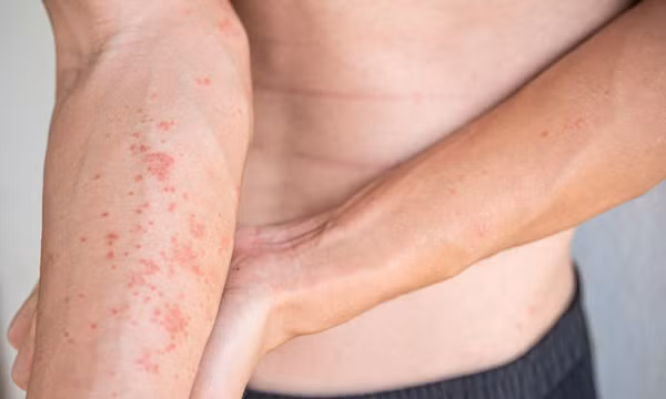 Cảnh giác với viêm da tiếp xúc dị ứng