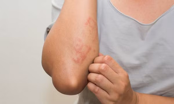 Mẩn đỏ, ngứa khắp người là biểu hiện của bệnh gì?