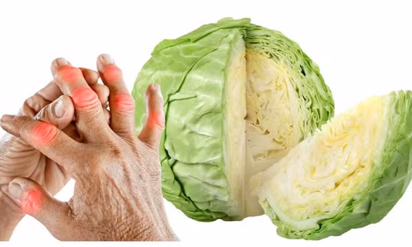 Bệnh gút cải thiện nhờ bắp cải