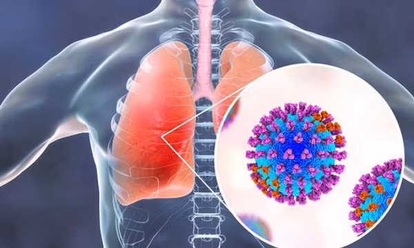 Chăm sóc bệnh nhân viêm phổi do virus