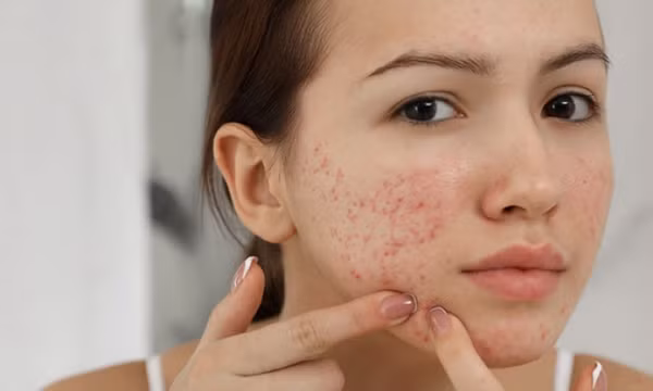 Nguyên nhân khiến da mụn mãi không khỏi