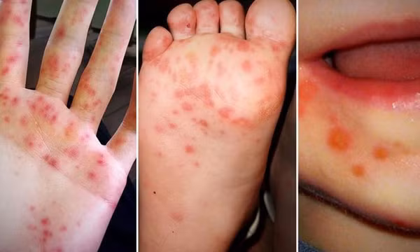 Bác sĩ chỉ ra 6 sai lầm khi dùng thuốc trị tay chân miệng