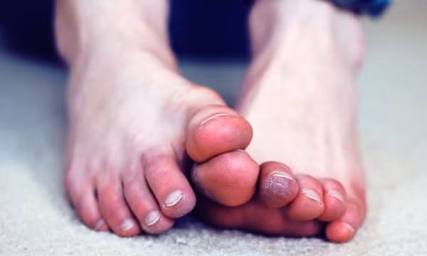 Dấu hiệu ở bàn chân chứng tỏ bạn đang có đường huyết quá cao